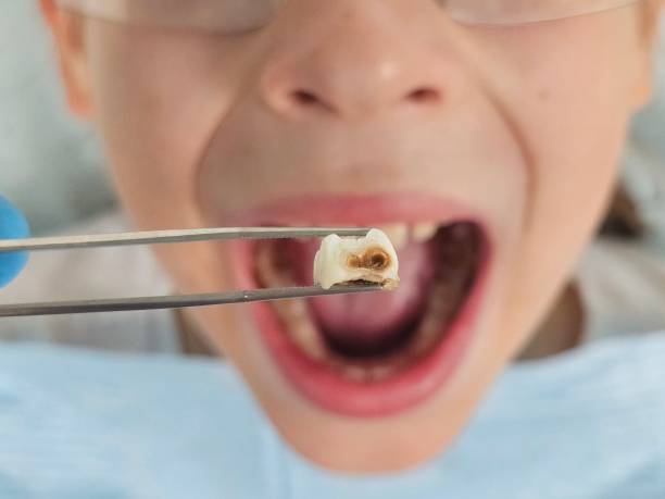 Best Emergency Tooth Extraction in Stroville, CA